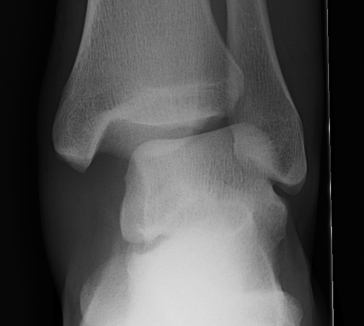 Ankle Fracture Increased Medial Clear Space 2